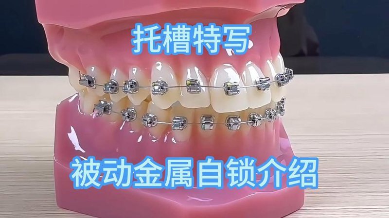 牙齿矫正:从困惑走向自信的笑容